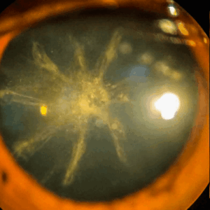cataract