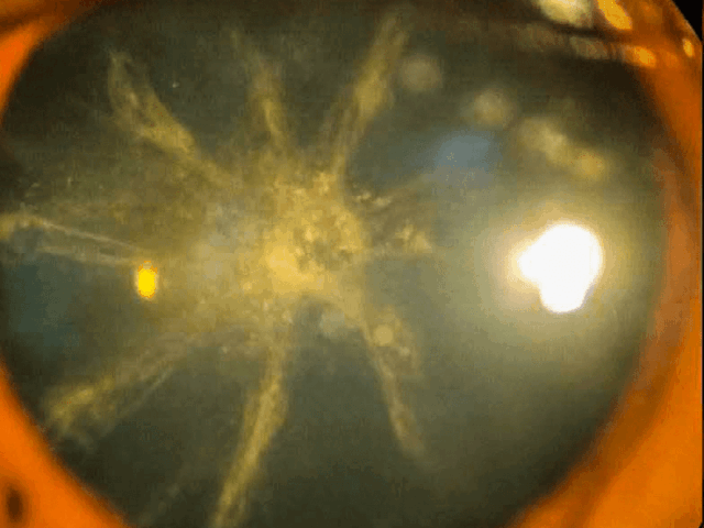 Cataracts: Regain Clear Vision with Modern Cataract Surgery