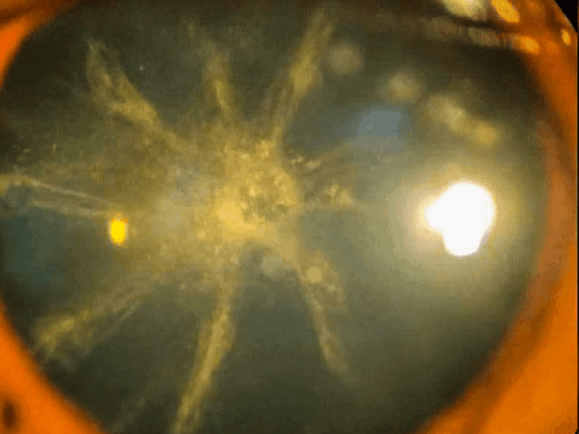 Cataracts: Regain Clear Vision with Modern Cataract Surgery