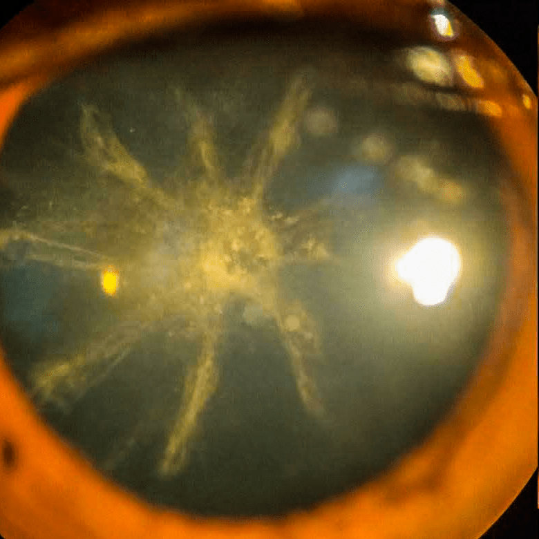 Cataracts: Regain Clear Vision with Modern Cataract Surgery