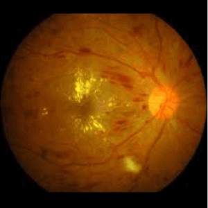Diabetic Retinopathy