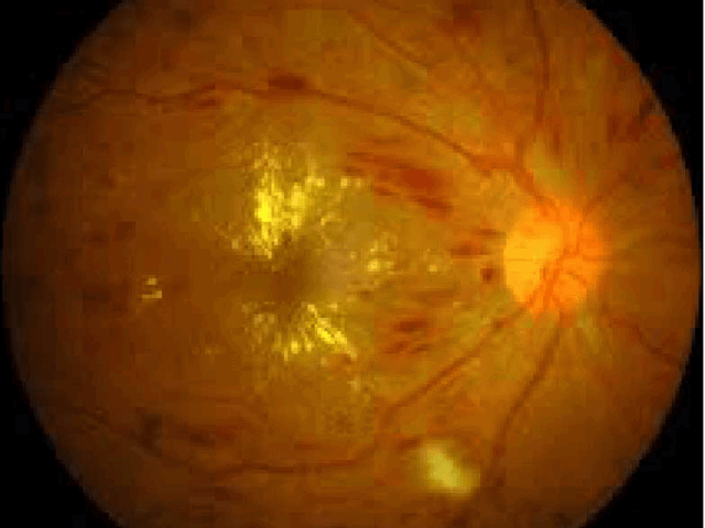 See Clearly: A Guide to Common Retinal Diseases