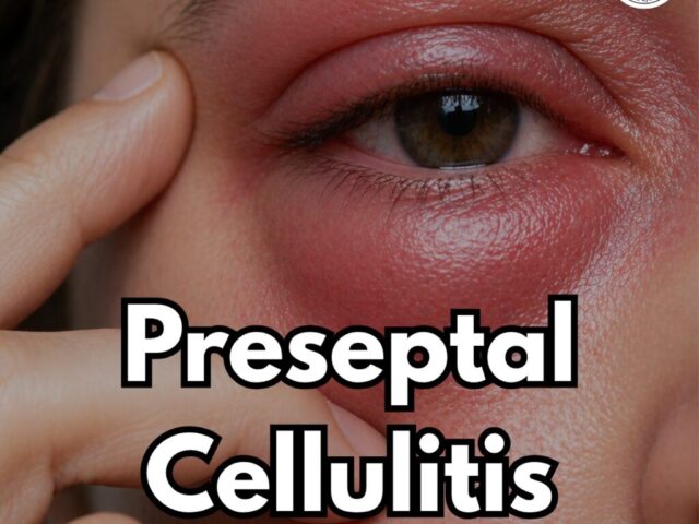 What Is Preseptal Cellulitis and When Should You Worry About It?