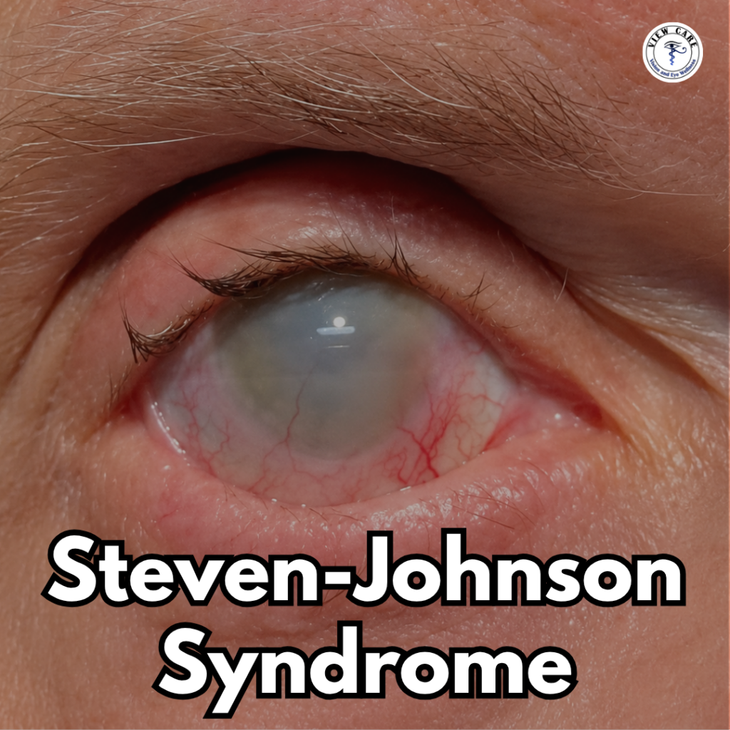 Could Steven-Johnson Syndrome Affect Your Eyes? Here’s What You Need to Know