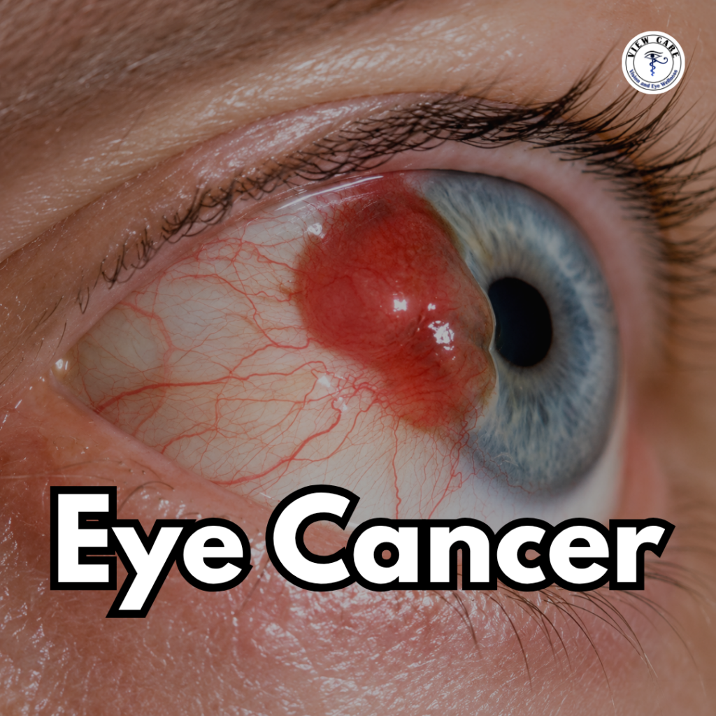 Why Should Eye Cancer Be Treated by an Eye Cancer Specialist Instead of a General Cancer Specialist?