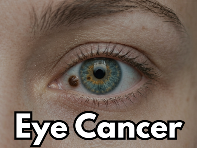 Can Eye Cancer Be Treated Successfully? Everything You Need to Know About Eye Cancer and Surgery