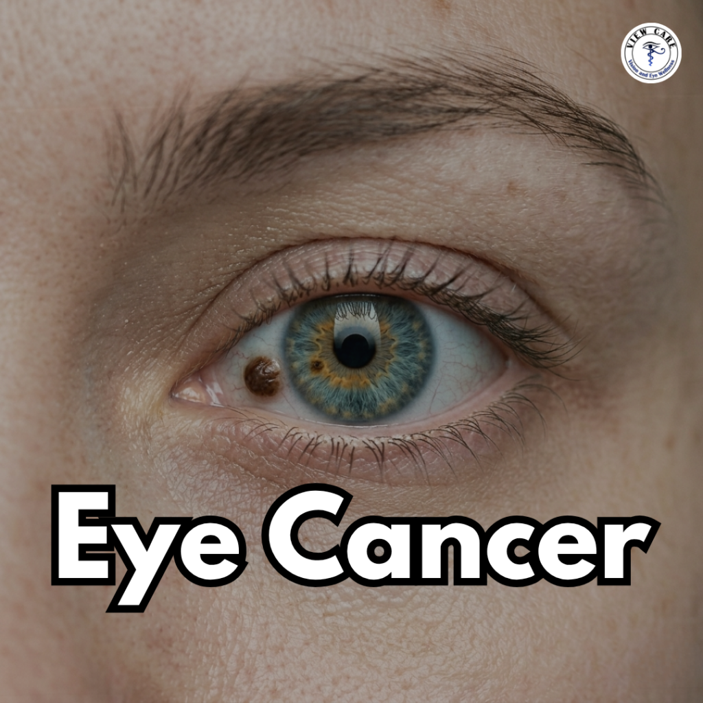 Can Eye Cancer Be Treated Successfully? Everything You Need to Know About Eye Cancer and Surgery