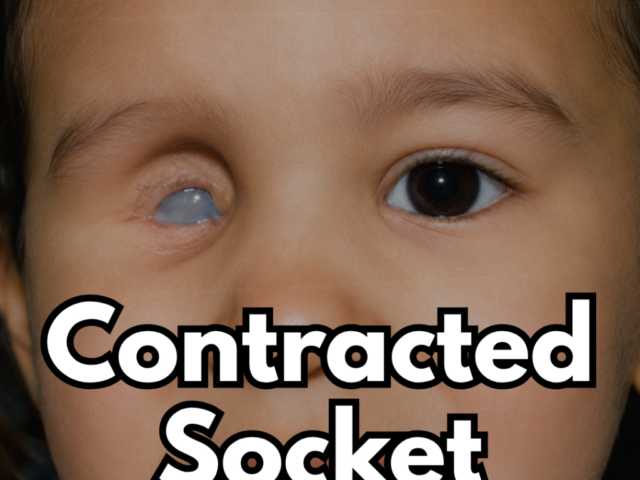 Is a Contracted Socket Making It Difficult to Wear an Artificial Eye? Here’s Everything You Need to Know