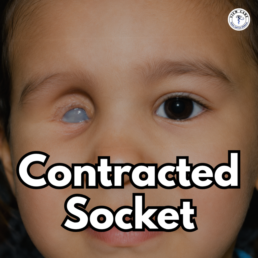 Is a Contracted Socket Making It Difficult to Wear an Artificial Eye? Here’s Everything You Need to Know