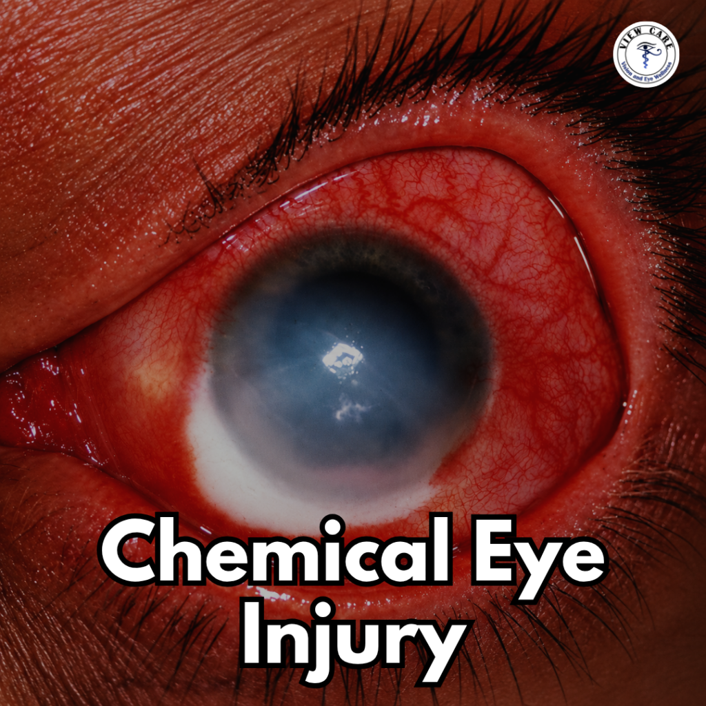 Chemical Injury to the Eyes: What Should You Do Immediately to Save Your Vision?