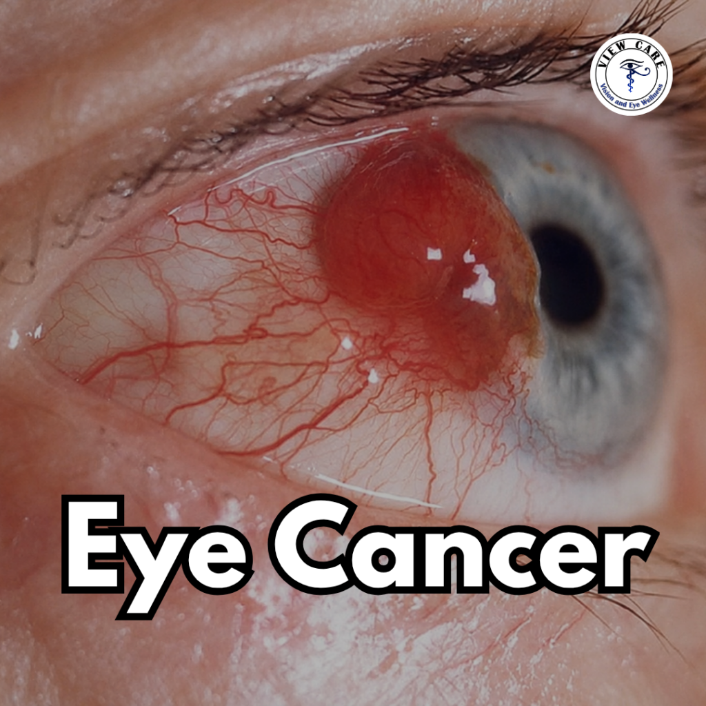 Can Eye Cancer Be Treated Successfully? Everything You Need to Know About Eye Cancer Treatment
