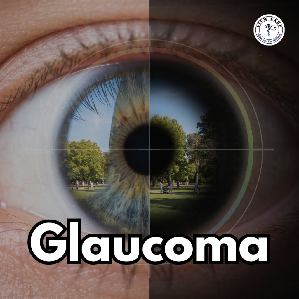 What Is Glaucoma and How Can You Protect Your Vision Before It’s Too Late?
