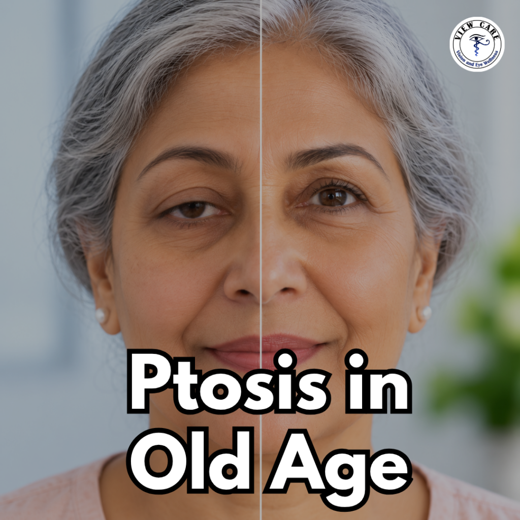 Droopy Eyelids (Ptosis): When Is It More Than Just Aging?